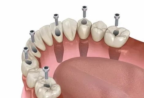 All-on-4 full arch example in Turkey