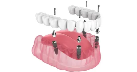 All-on-4 and All-on-6 full-arch smile example in Turkey
