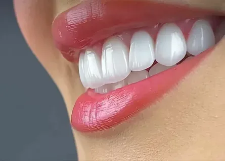 Hollywood Smile design
