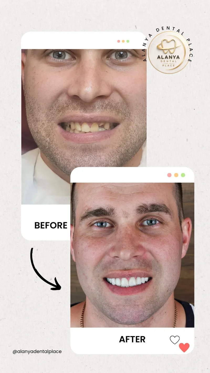 Dental implant before and after - case 1