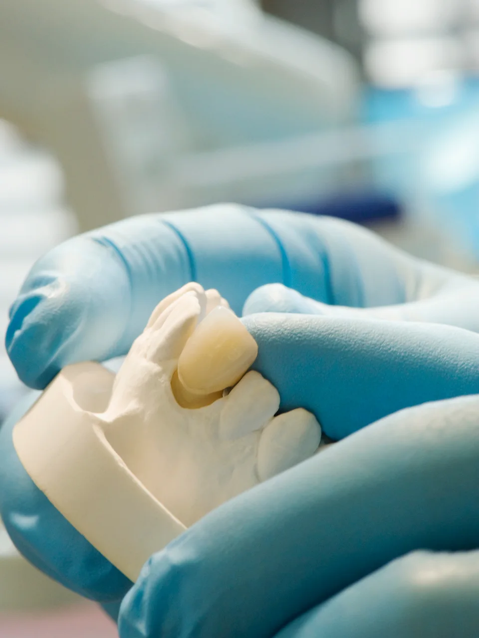 Zirconia crowns clinical example in Turkey